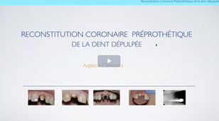 Reconstitution Corono radiculaire de la dent dépulpée: Aspects Cliniques.mp4