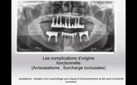 Occlusion en Implantologie Partie 1.mp4