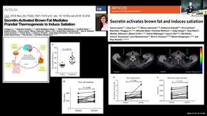 Human Brown Adipose Tissue in Obesity