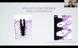 Implantologie Prothétique : 5 points essentiels avant de commencer.mp4