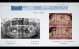 Critères Extrinsèques d'évaluation de la dent pilier.mp4